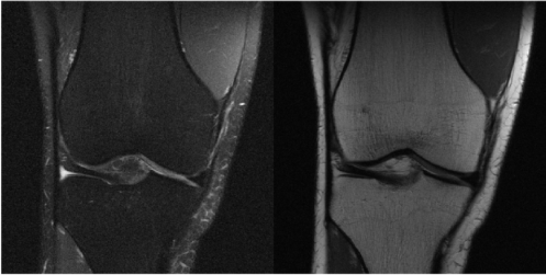 Knee images from fastmri dataset, left is proton density image with fat suppression, right is proton density image without fat suppression (Zbontar et al 2019)