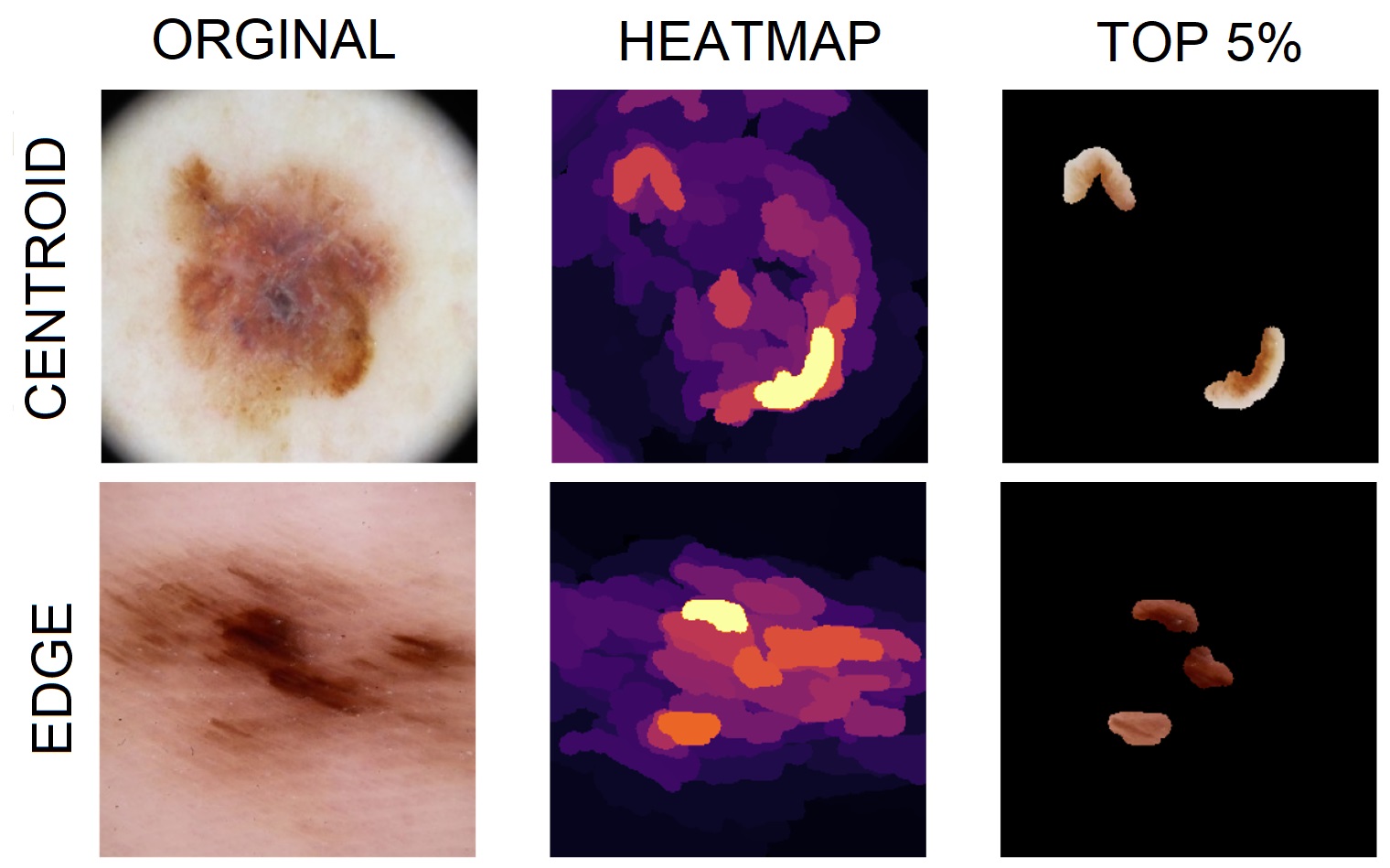 Two examples from the malignant class, which were found in the center, and in the boundary between two clusters respectively, examined using XRAI heatmaps.